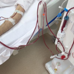 Understanding Dialysis: What&hellip;